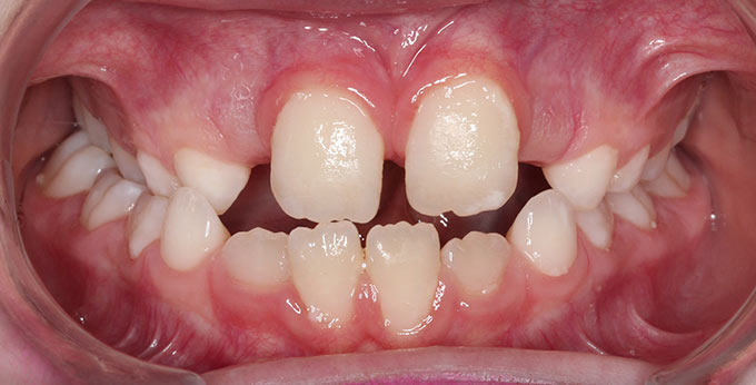 Before plate from treatment for right side cross bite with midline shift